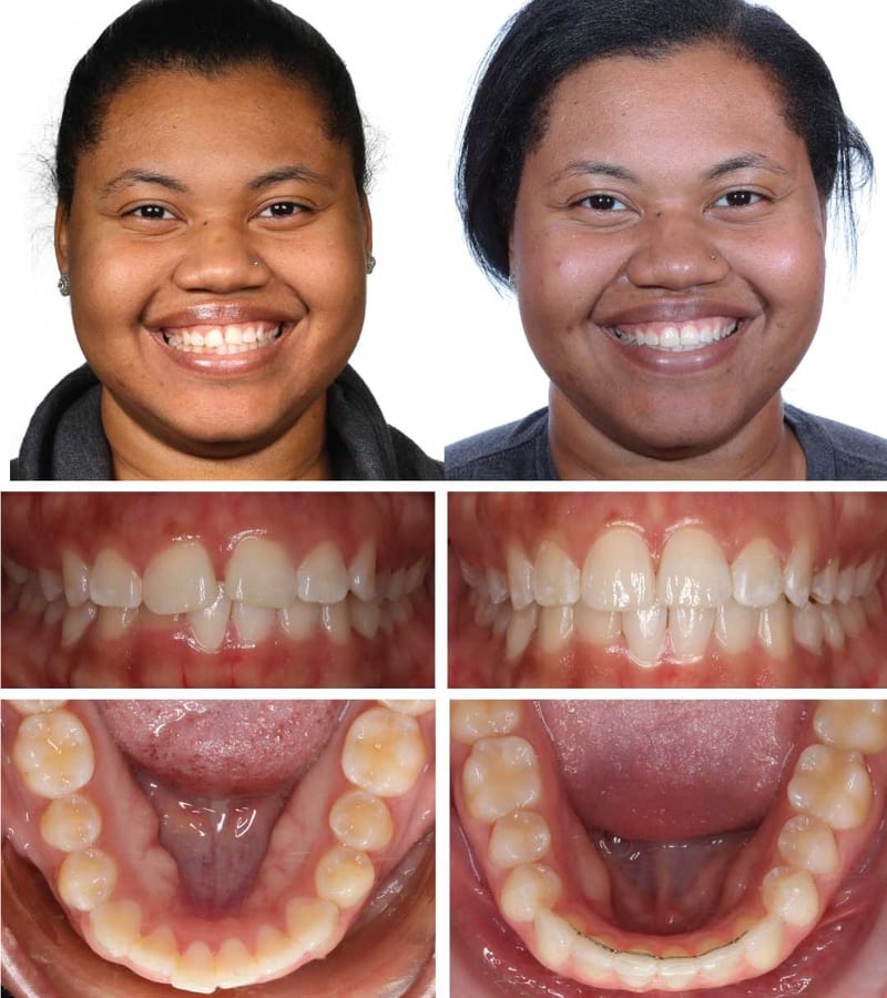 Invisalign in Platte City , Gladstone , Parkville , Invisalign in