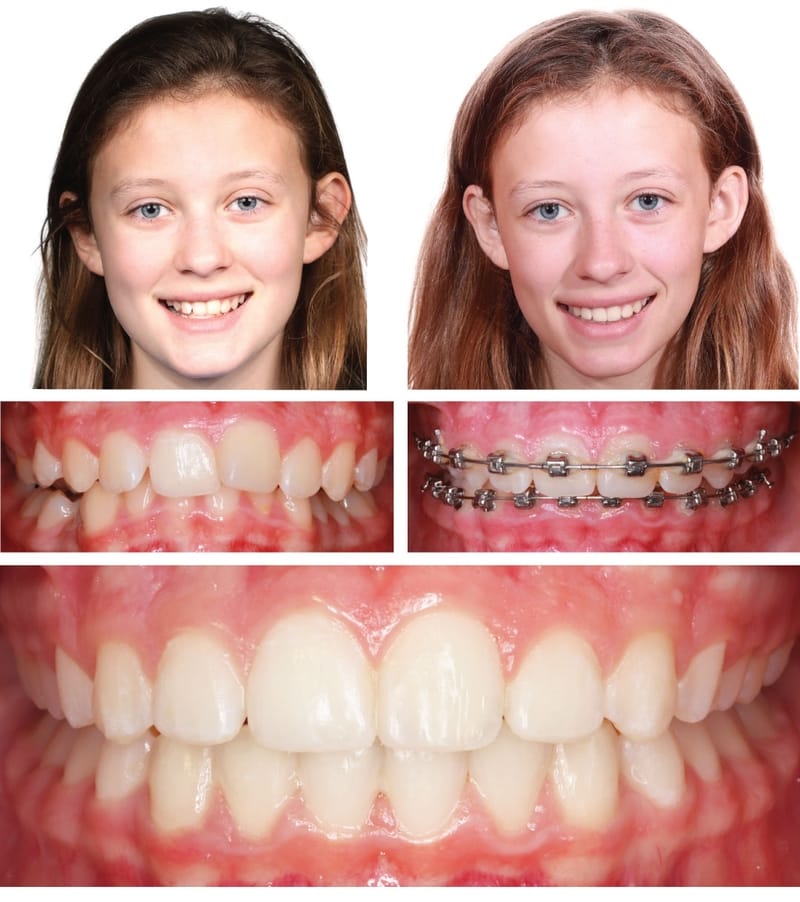 Orthodontics in Kansas City ,Gladstone Orthodontist ,Parkville