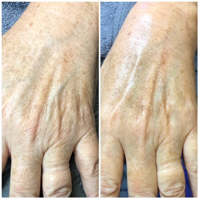 HydraFacial in Austin and Cedar Park TX | Clean Slate Waxing Lounge