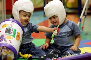 Conjoined Twins 10 Years