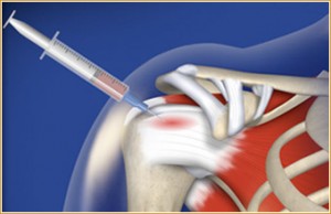 platelet-rich plasma therapy