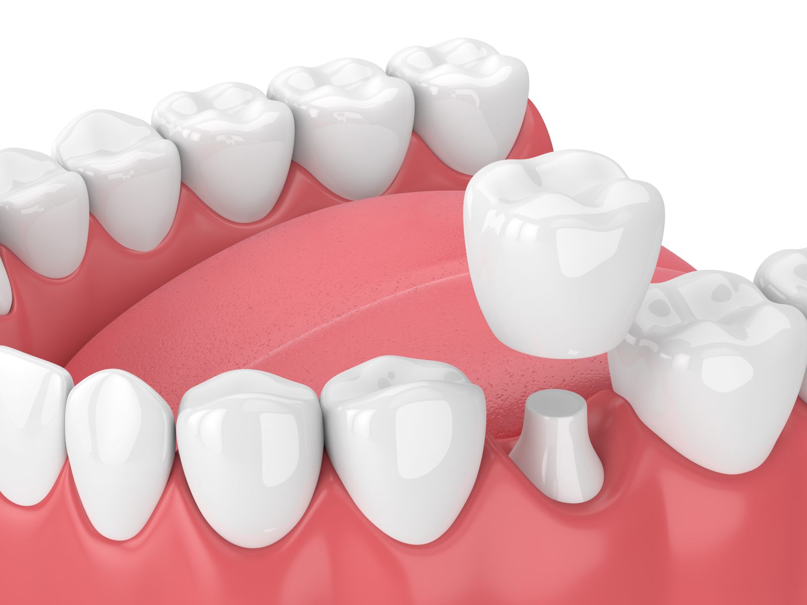 graphic of dental crown process