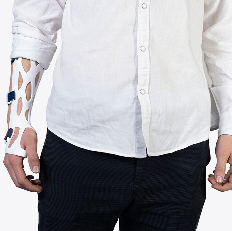 Impression 3D pour l'orthopédie avec une attelle sur mesure et aérée.