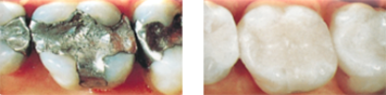 Before & After All Ceramic Fillings Dee Why