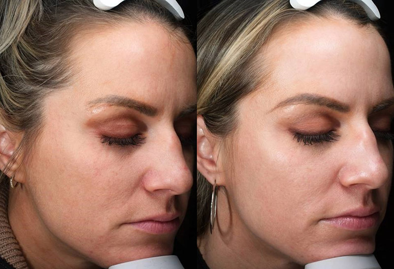 Virtue RF Microneedling at Elite Aesthetics – a Boston MedSpa