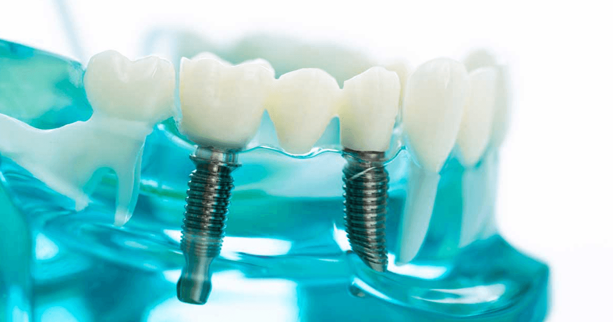 Dental Implants Bridgelake Family Dentistry
