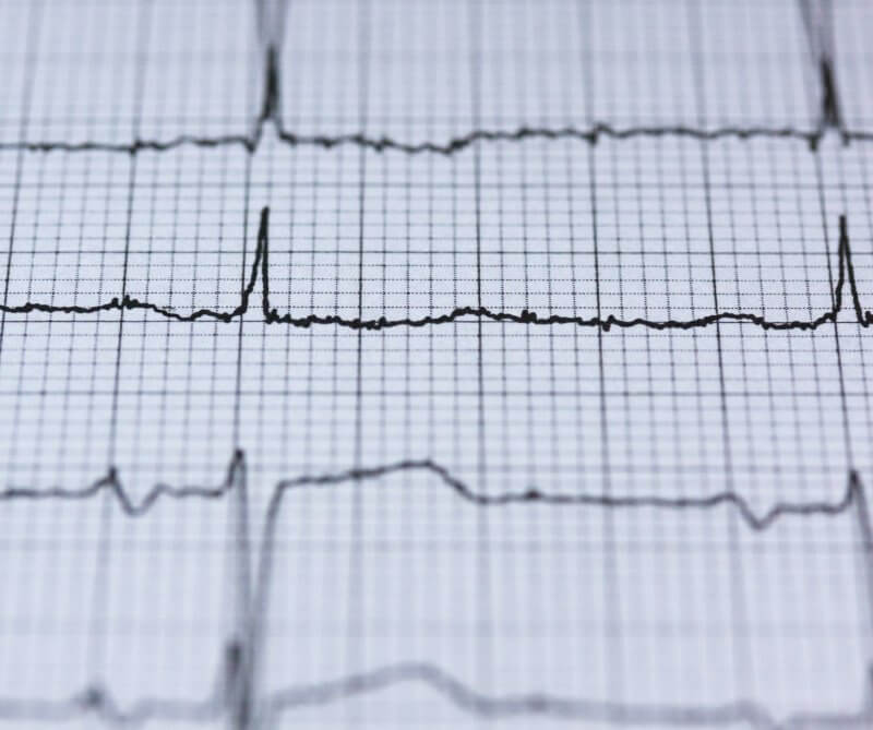 electrocardiogram reading on medical paper