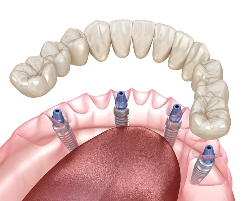 Explaining an upcoming procedure