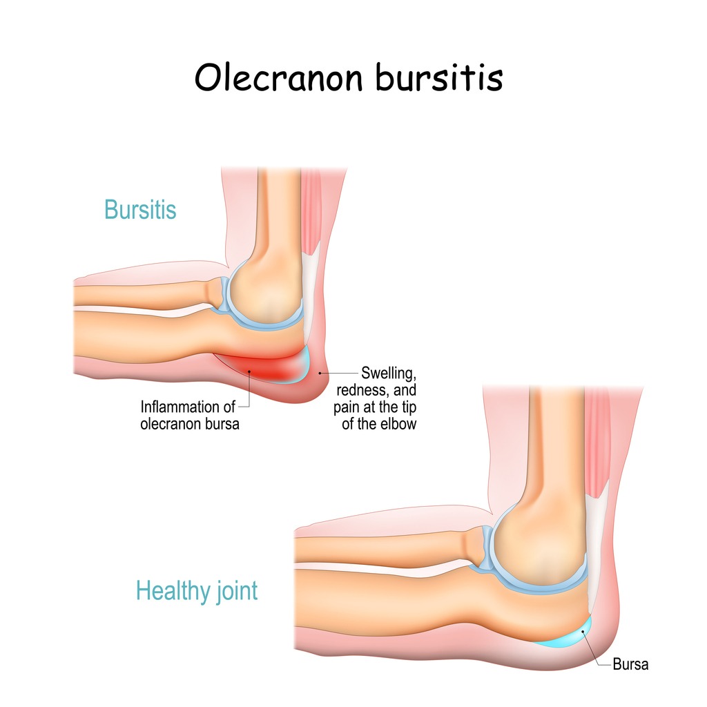 Olecranon bursitis