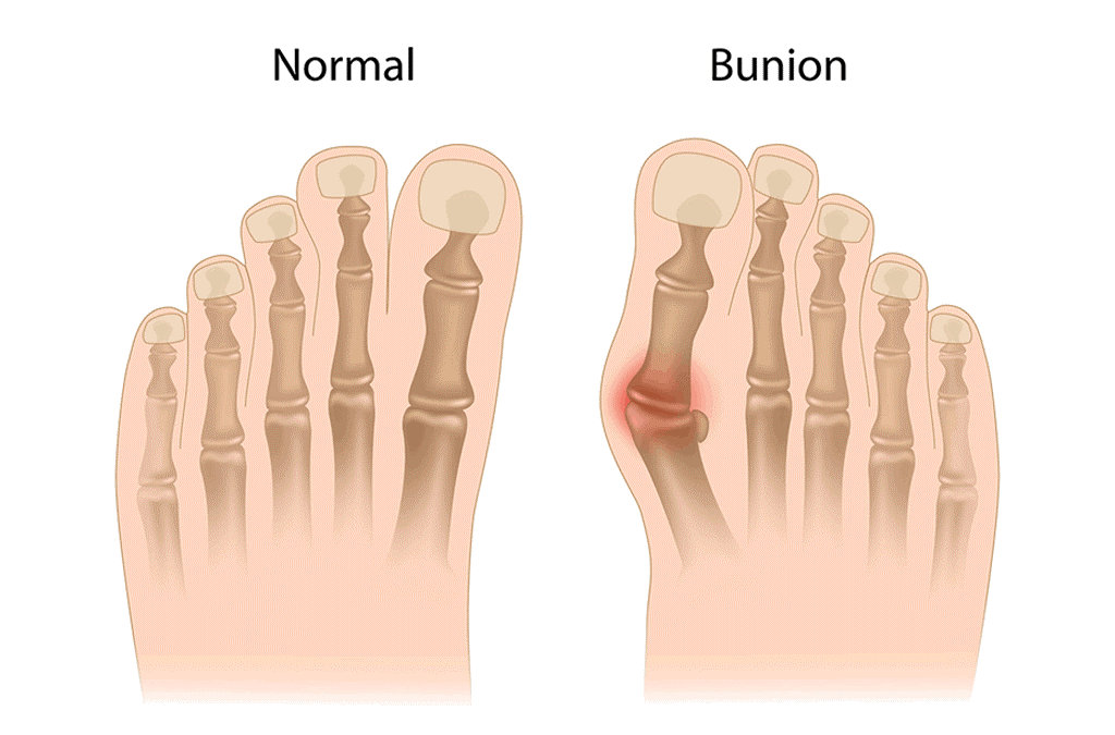Bunions