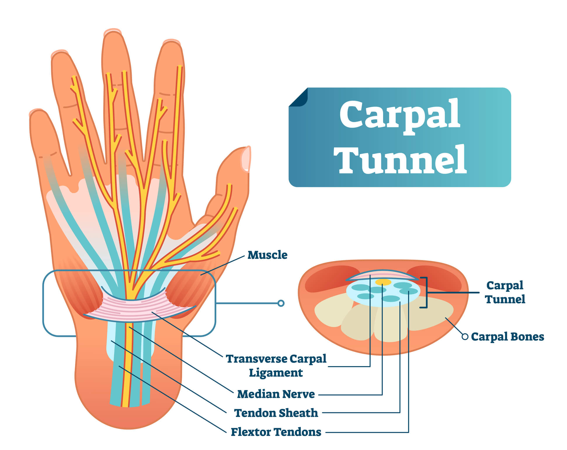 Carpal tunnel