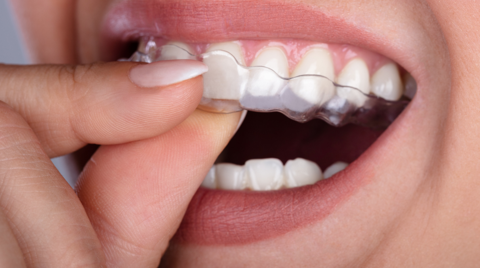 Closeup of person putting on Invisalign