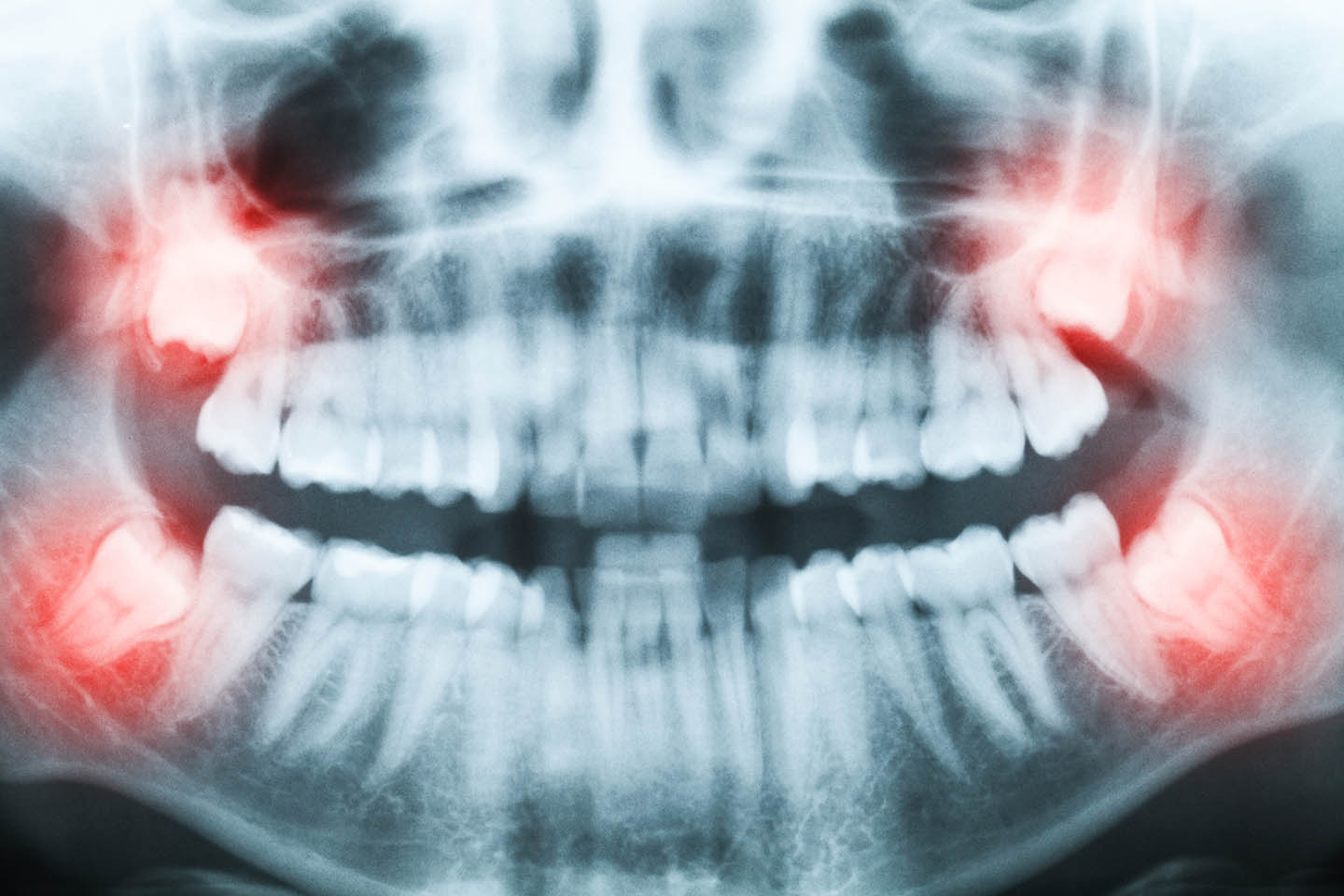 xray of mouth with teeth pain