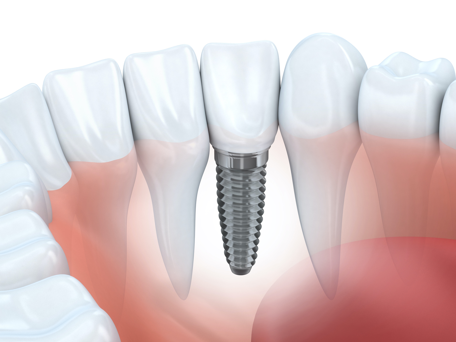 full arch implant