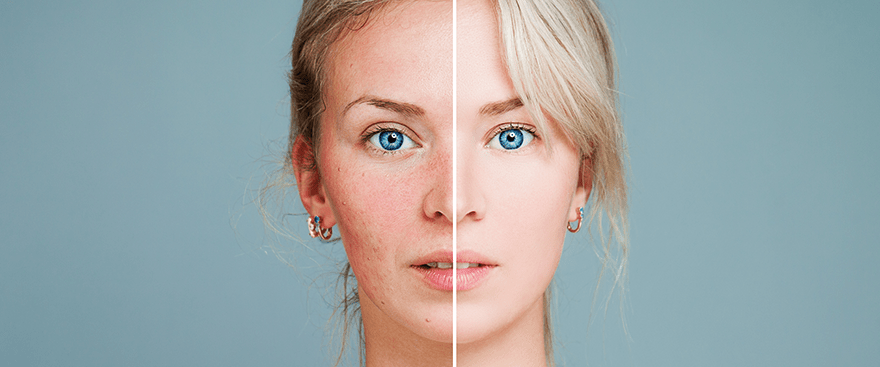 TCA Peels® only last 10-15 minutes, and recovery time is fairly short.