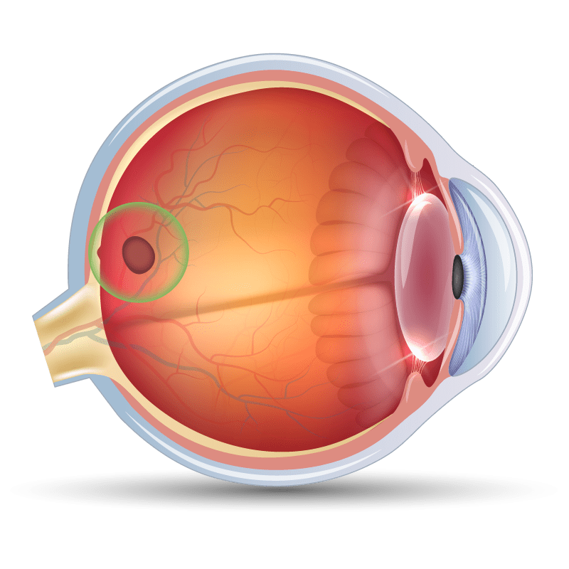 Colorado Retina Retinal Conditions We Treat