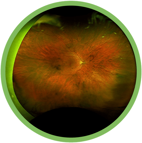 Colorado Retina Vitreous Detachment