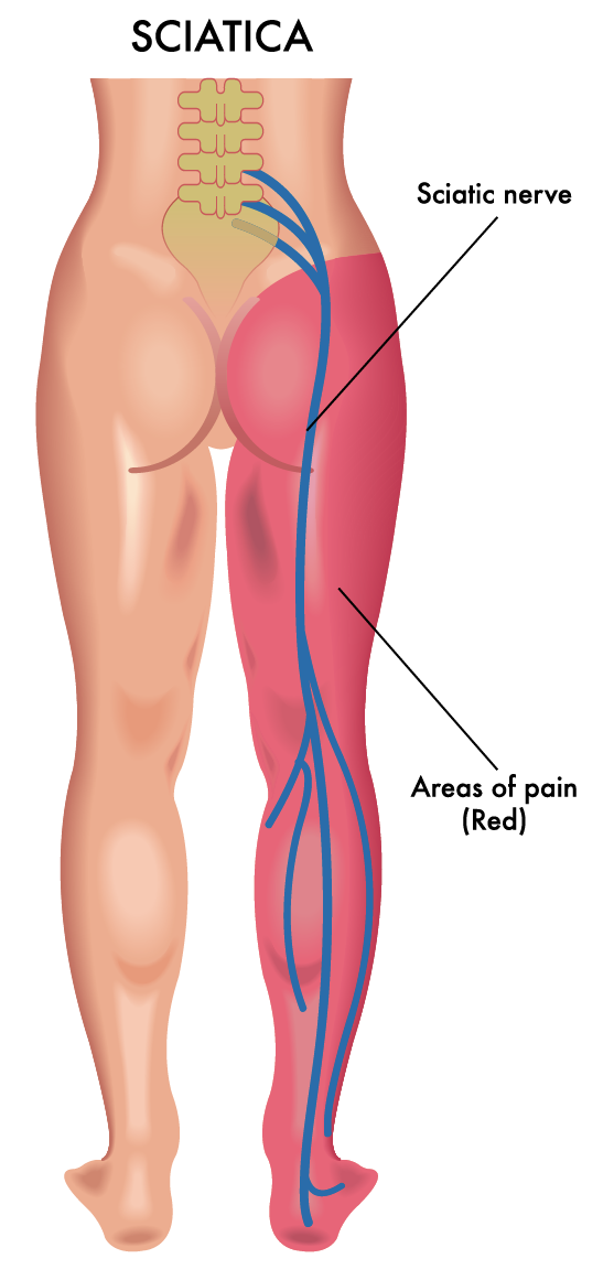 Sciatica