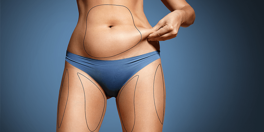 Liposculpture (Fat Transfer) patient