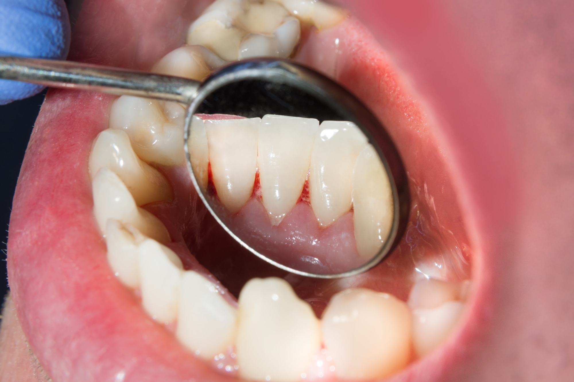 dentist harding dental bond with a light