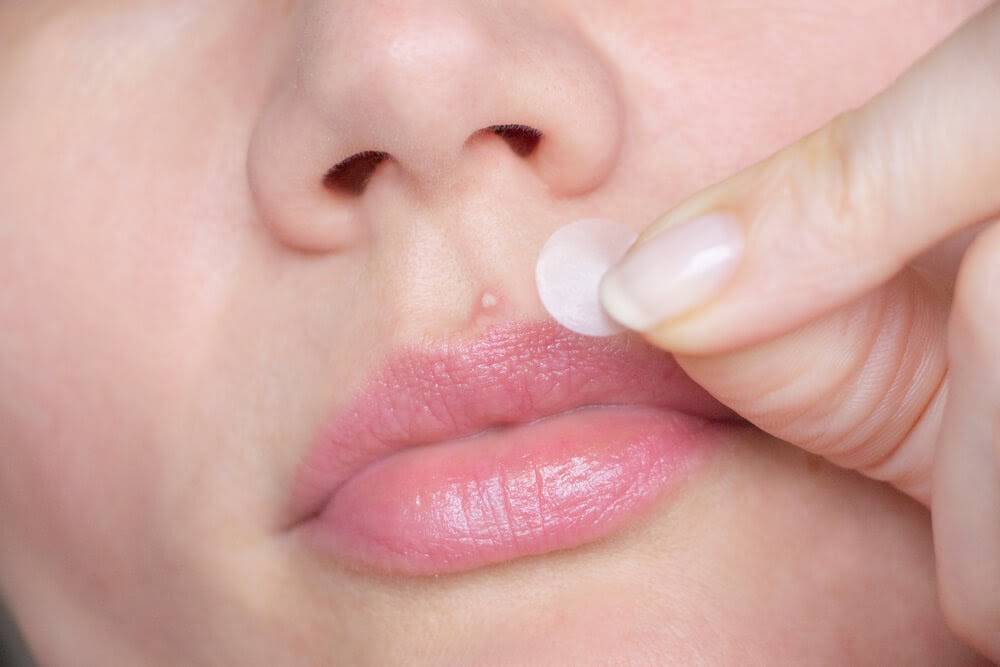 Woman putting a patch on a whitehead abover her lip
