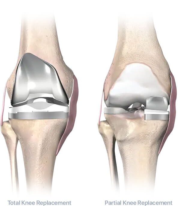 Total Knee and Partial Knee Mako Robotic-Arm Assisted Joint Surgery for Total Knee Replacement Partial Knee Replacement Steward Health Care Utah Orthopedics Jordan Valley Medical Center