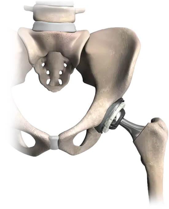 Total Hip Replacement Mako Robotic-Arm Assisted Joint Surgery for Hip Replacement Steward Health Care Utah Orthopedics Jordan Valley Medical Center