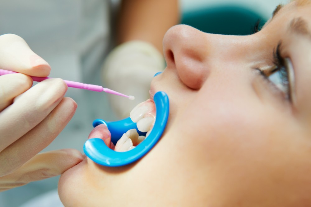 a child receiving a fluoride treatment where dental hygienist paints on fluoride