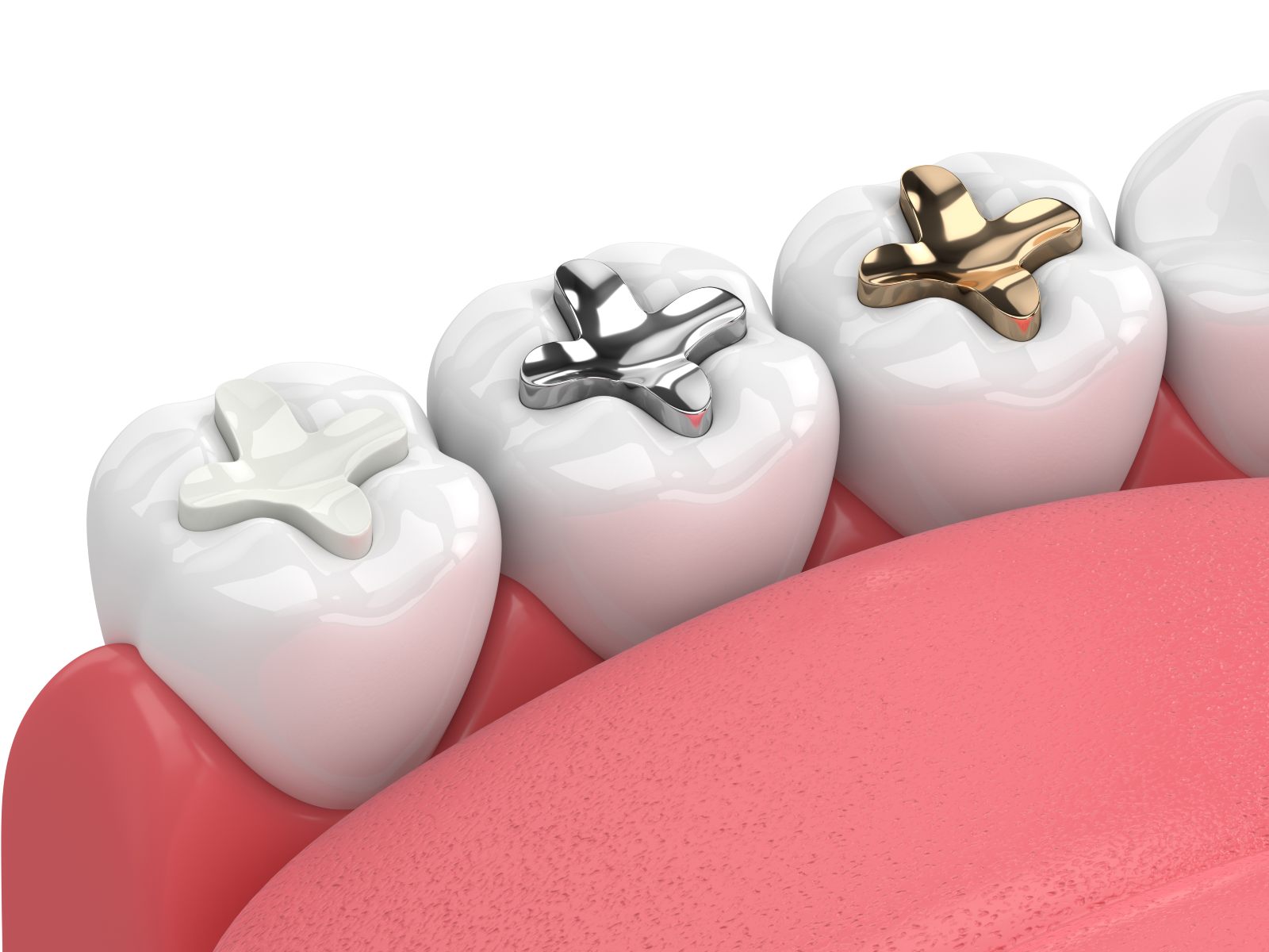 different colored and material dental fillings in a mouth