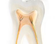 Root Canal Tooth