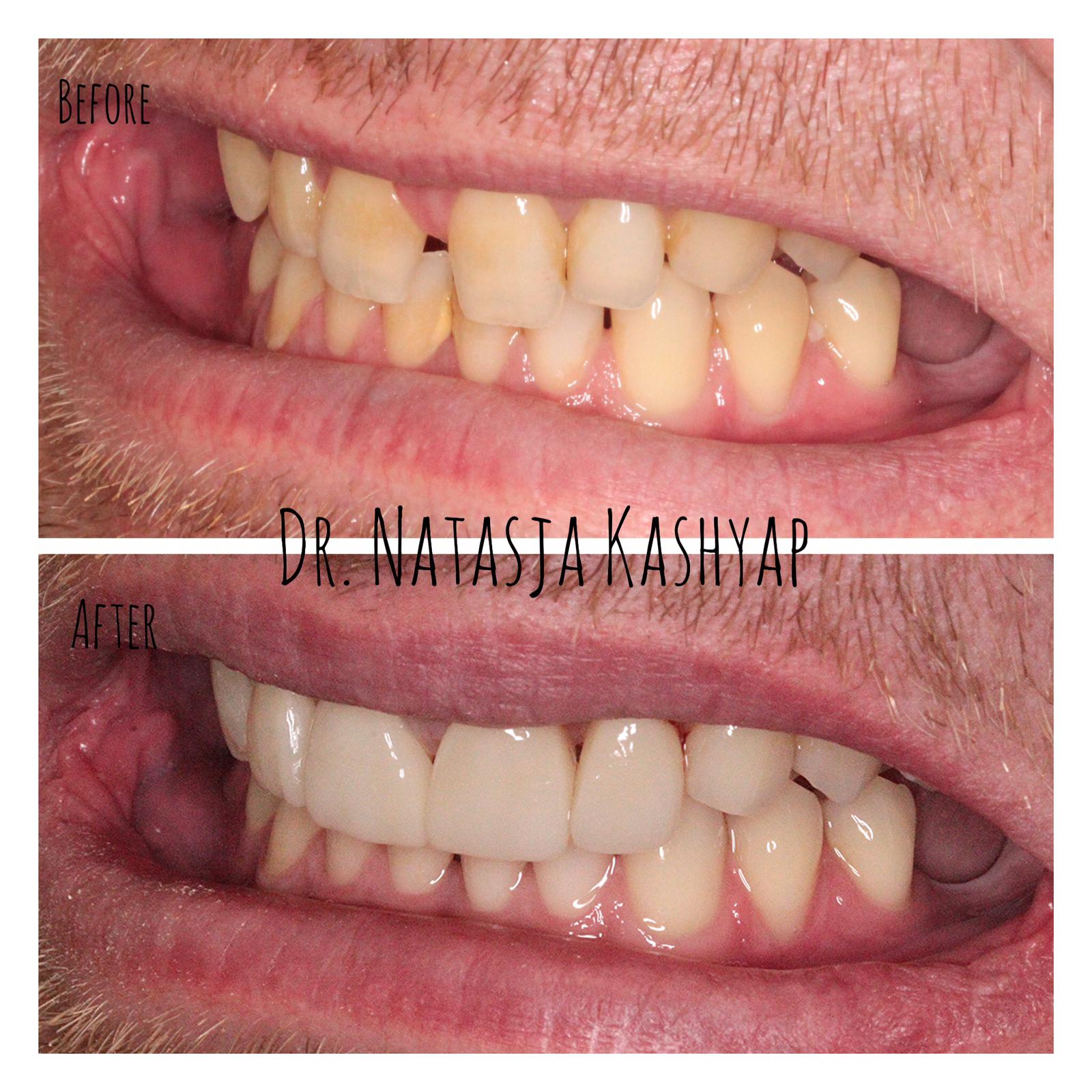 Teeth Whitening Gallery Brunner Court Dental & Implant Practice