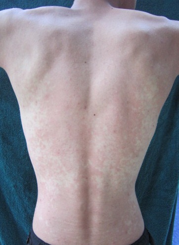 Wine Allergy Rash on Back