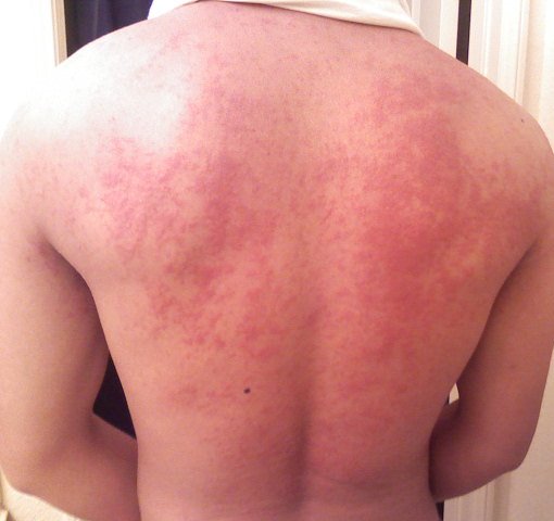 Hives on back