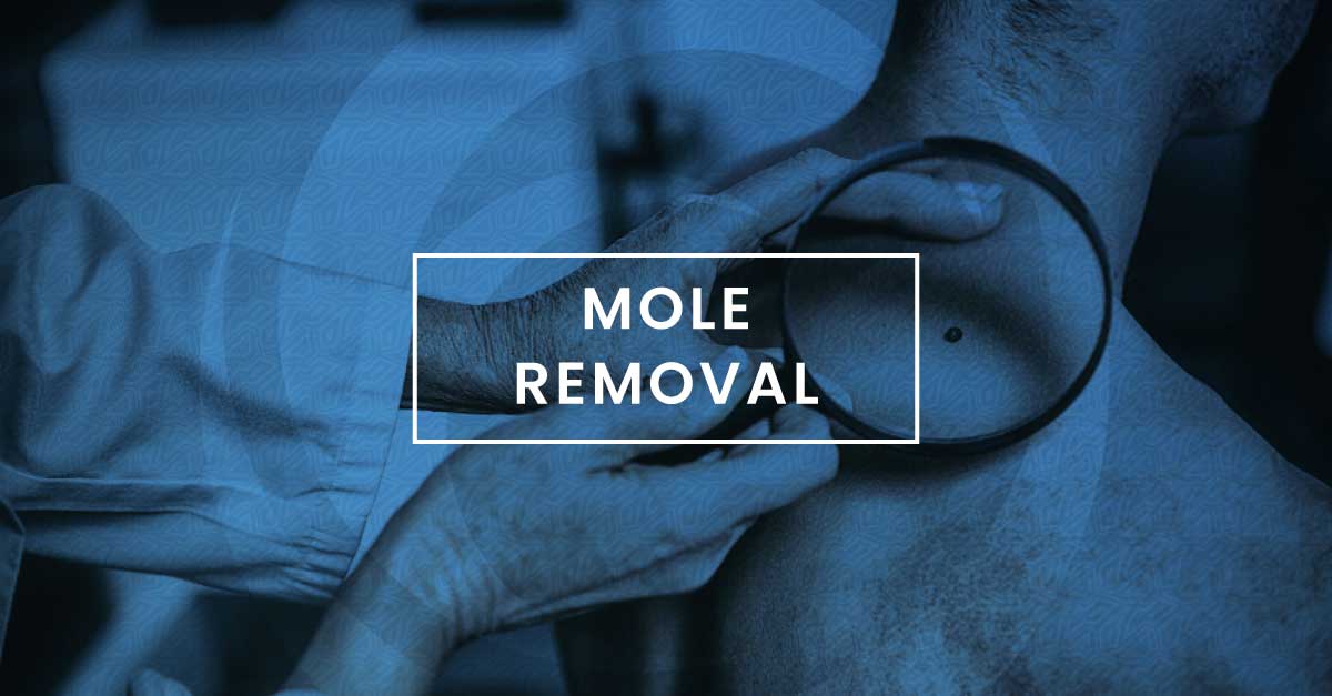 Inoffice Cosmetic Mole Removal Tulsa How to Get a Mole Removed