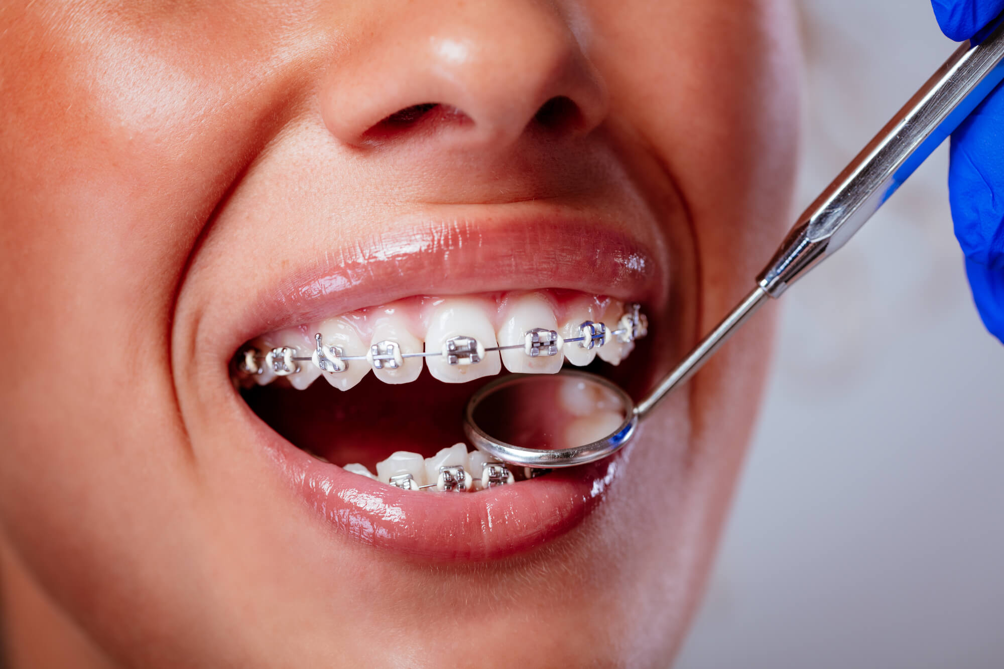 How to Manage Braces