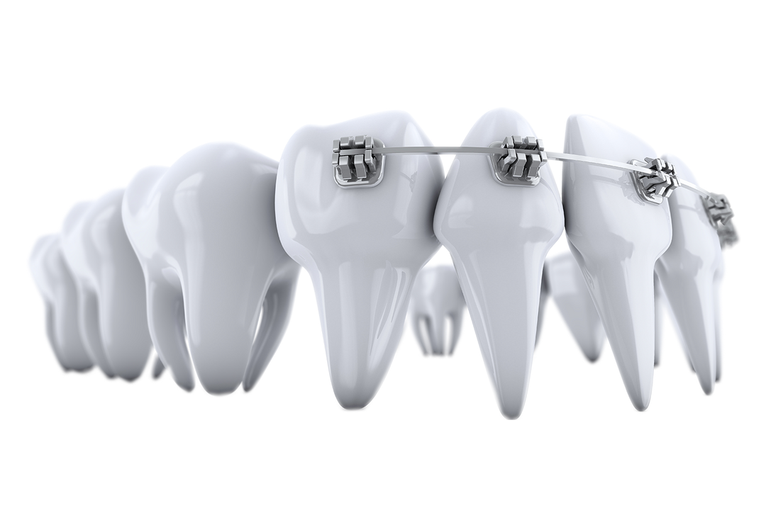 Metal Braces HRS Dental Care in Gloucestershire