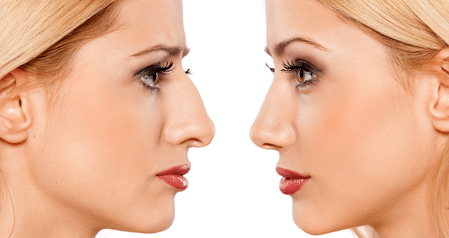 Candidate for Rhinoplasty surgery