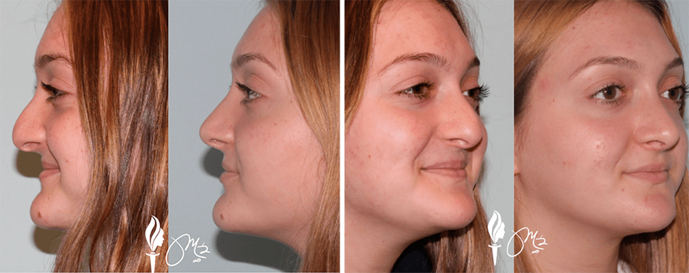 Rhinoplasty-1