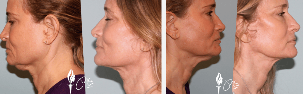 Face and Neck Rejuvenation 3