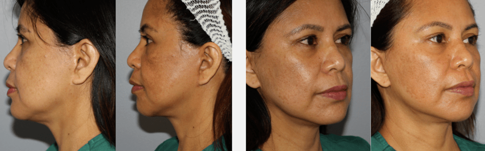 Face and Neck Rejuvenation 4