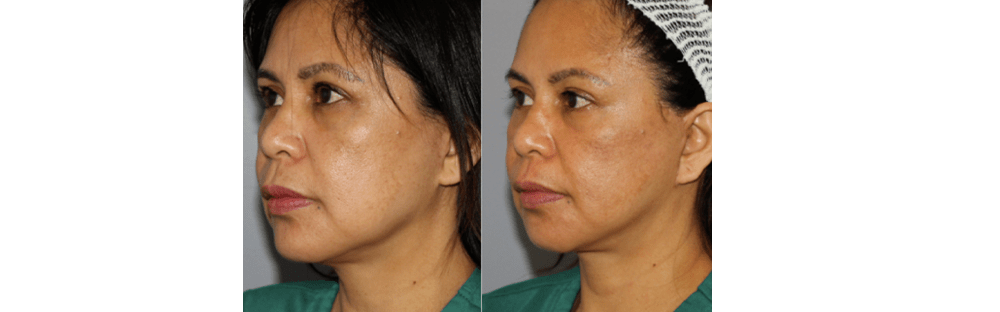 Face and Neck Rejuvenation 5