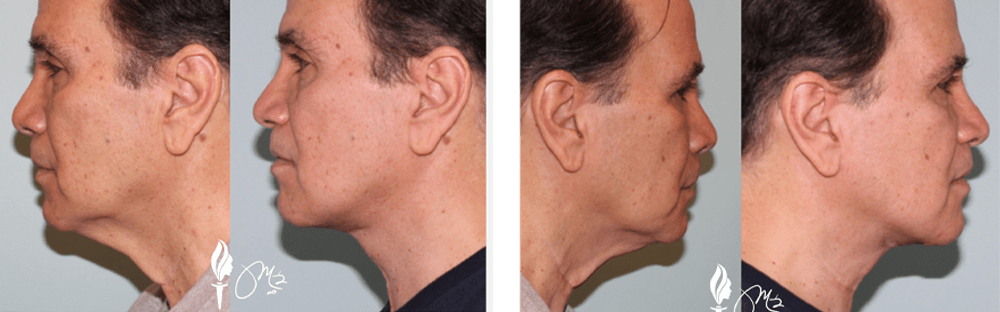 Face and Neck Rejuvenation 6