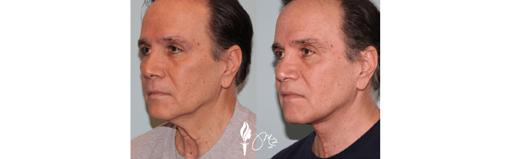 Face and Neck Rejuvenation 7