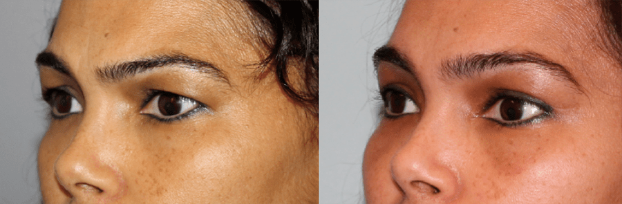 Brow & Eyelid Rejuvenation 1