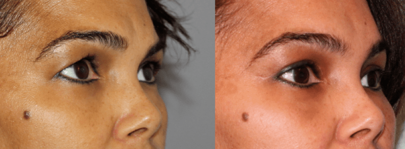 Brow & Eyelid Rejuvenation 2