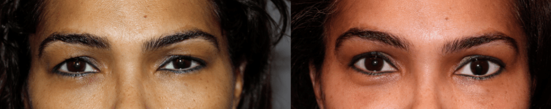 Brow & Eyelid Rejuvenation 3