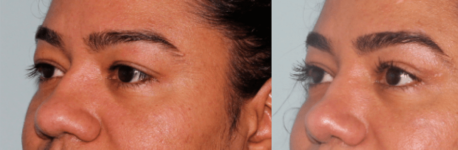 Brow & Eyelid Rejuvenation 4
