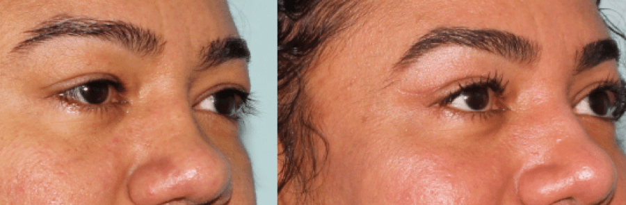 Brow & Eyelid Rejuvenation 5