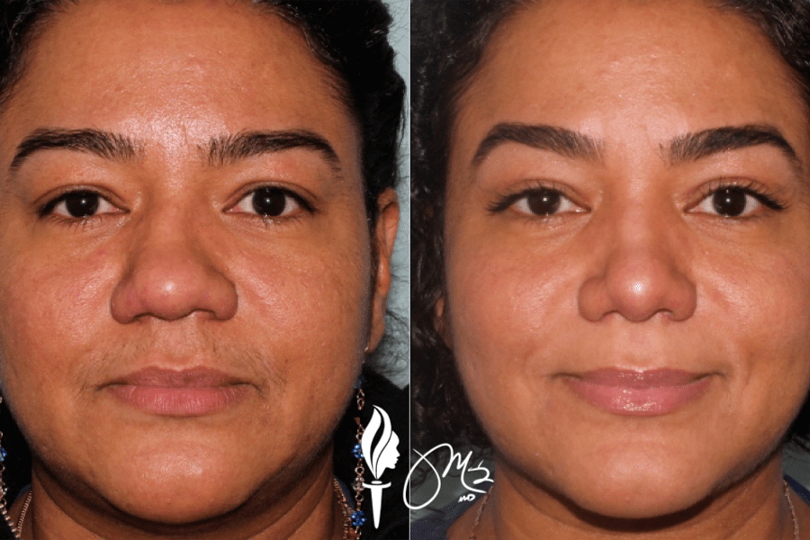 Brow & Eyelid Rejuvenation 6