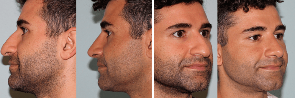 Rhinoplasty-2
